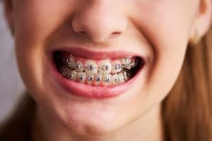 Kid with braces